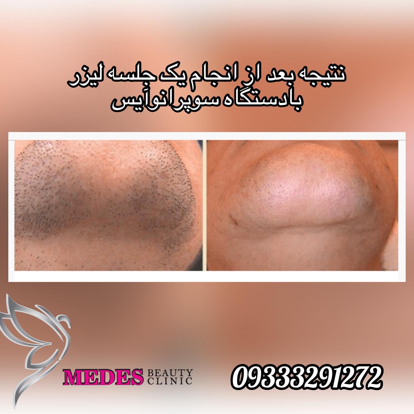 گالری لیزر مو زائد